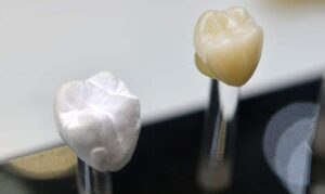 Dental Crown - Cosmetic Dentist Sugar Land or Katy, TX -