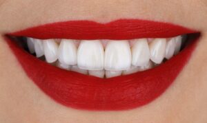 Porcelain Veneers - Cosmetic Dentist Sugar Land or Katy, TX 