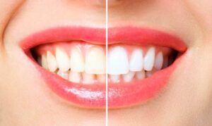 Teeth Whitening - Cosmetic Dentist Sugar Land or Katy, TX -