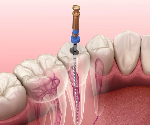 Dental implant procedure illustration showing tooth root placement with surgical instrument and gum tissue.