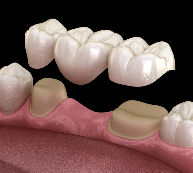 Dental implant crown restoration showing prosthetic teeth placement on gum model against black background