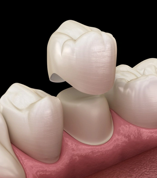 Dental crowns placed on tooth models demonstrating restorative dentistry procedures and tooth restoration techniques.