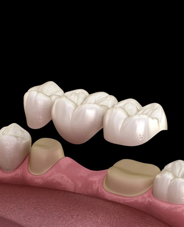 Dental crowns displayed on pink gum model showing tooth restoration options and placement.