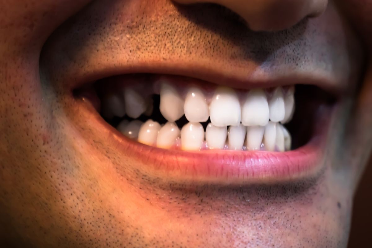 Best Tooth Replacement Options After Extraction