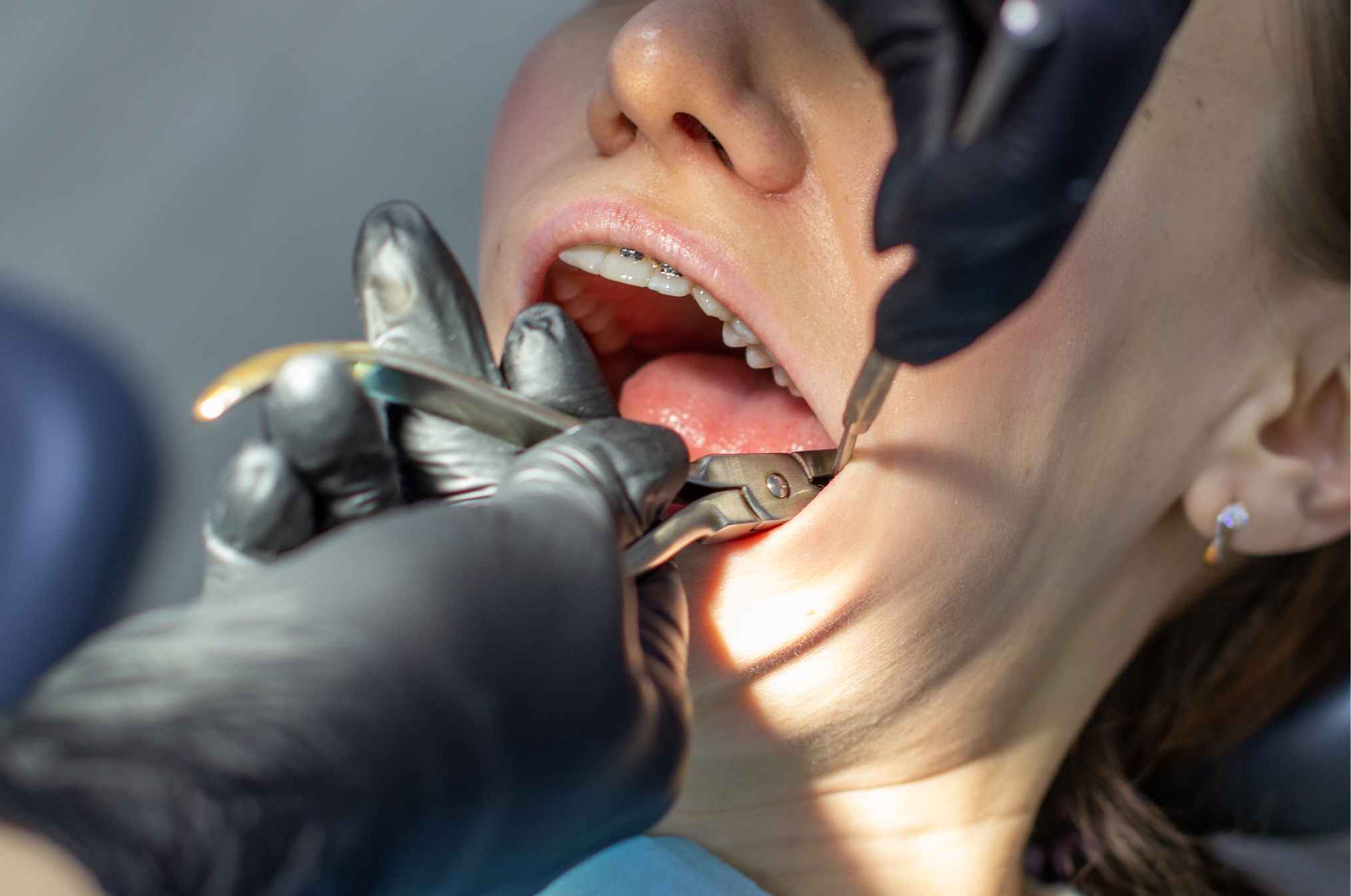 Dentist performing a wisdom tooth extraction as part of wisdom teeth removal treatment in Sugar Land, TX